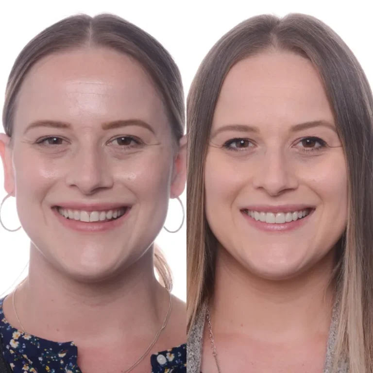 Smile Transformation Result 4