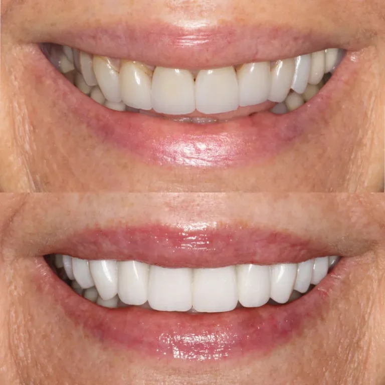 Smile Transformation Result 1