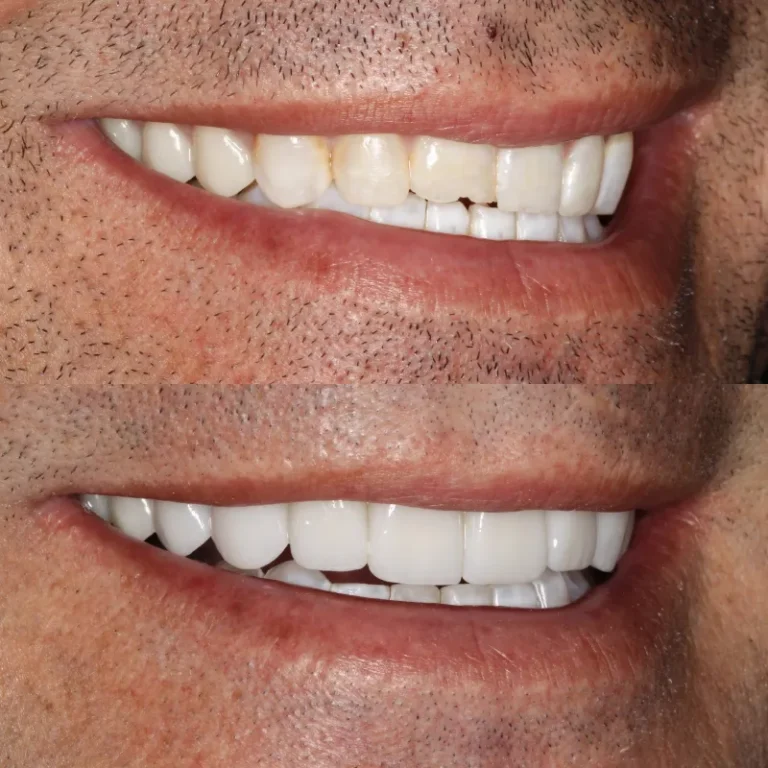 Smile Transformation Result 7