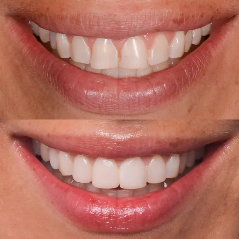 Smile Transformation Result 5
