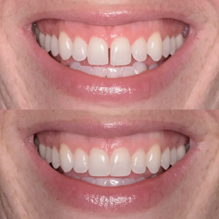 Smile Transformation Result 2