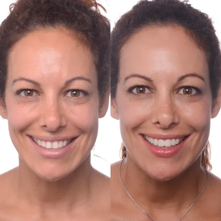 Smile Transformation Result 3