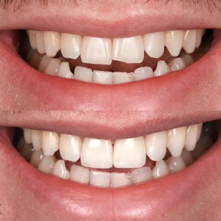 Smile Transformation Result 6