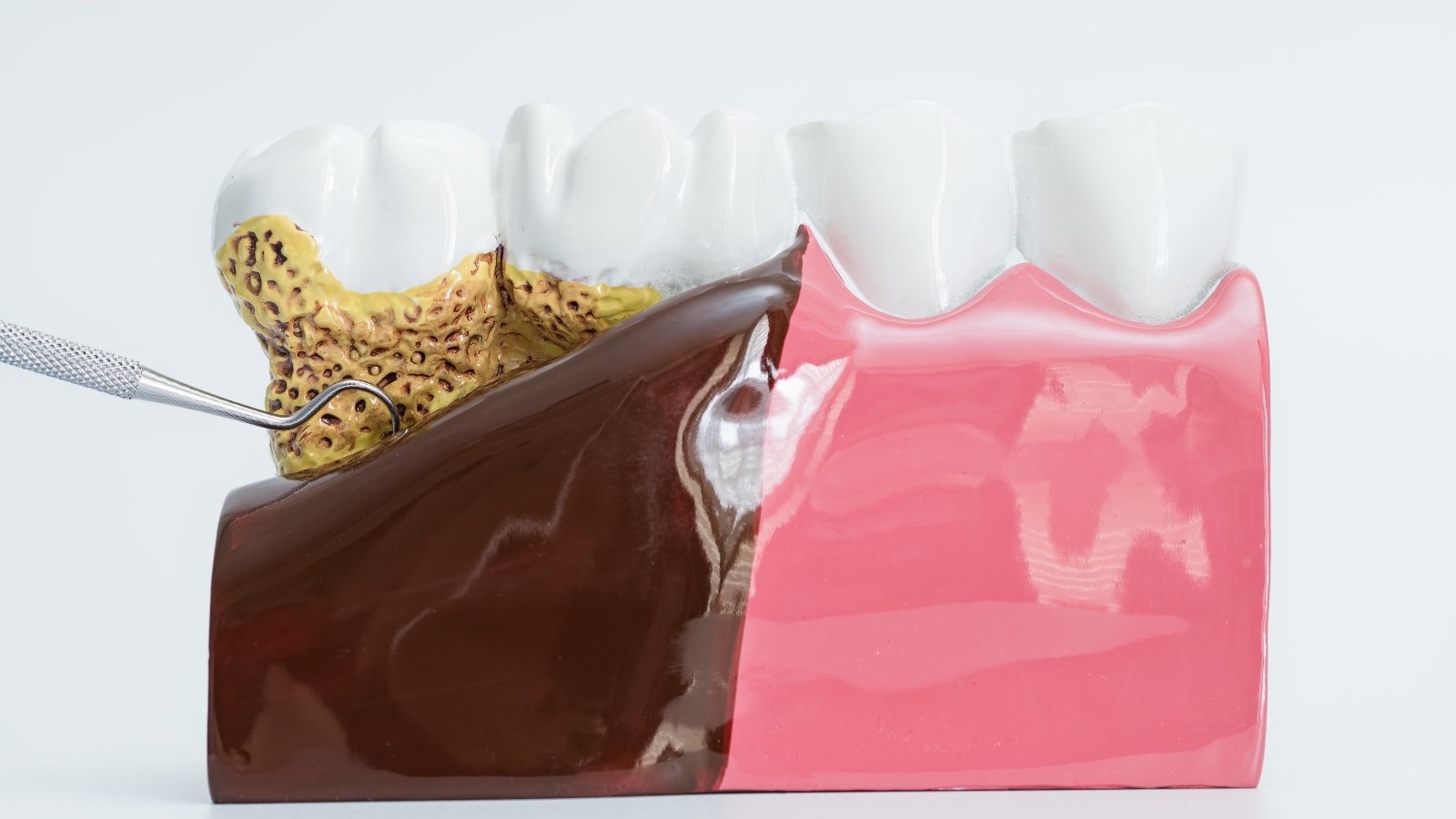 Periodontal Treatment & Management