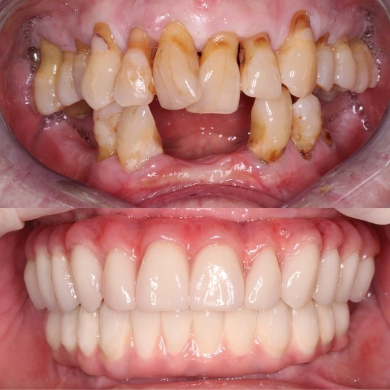 Smile Transformation Result 8
